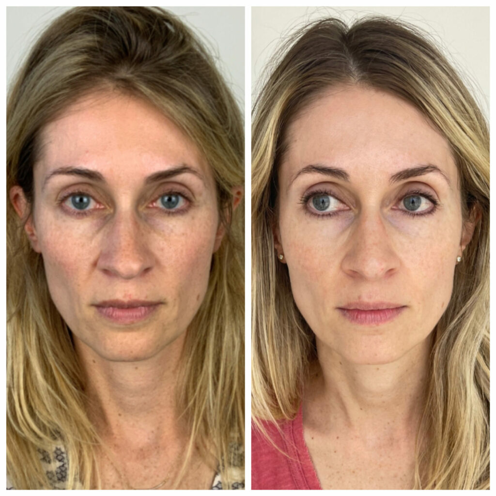 Sculptra treatment before and after Dubai
