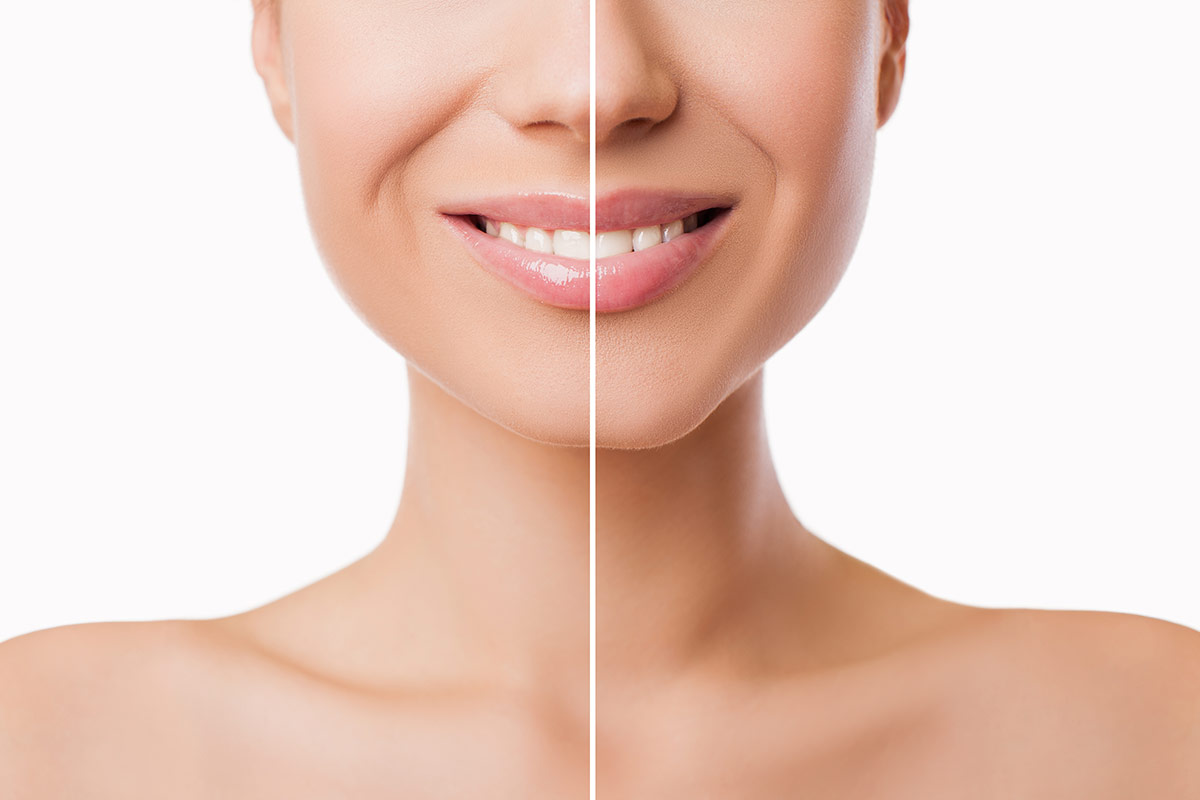 Sculptra in Dubai, Sculptra Dubai