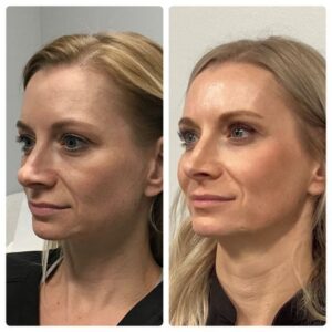Sculptra treatment in Dubai