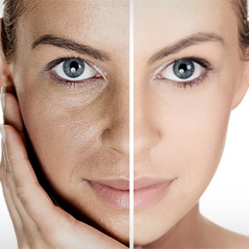 Sculptra in your 30s, Sculptra Dubai