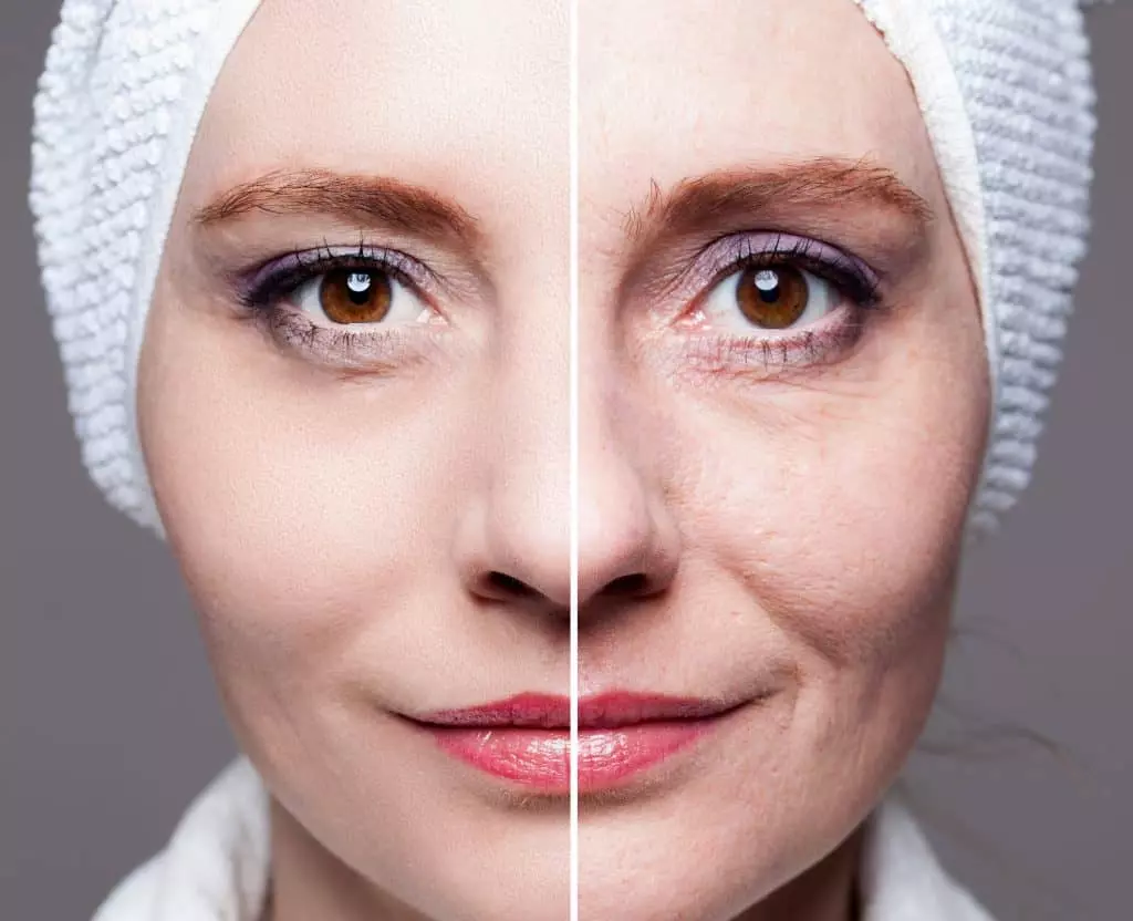 sculptra for long lasting results in Dubai